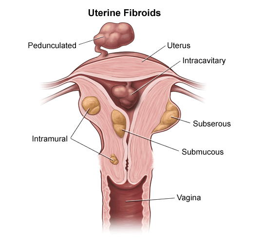 Uterine Fibroids