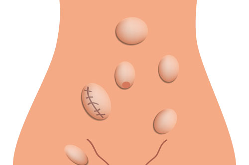 illustration of hernia locations