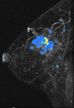 MIP (Maximum Intensity Projection) image of MR