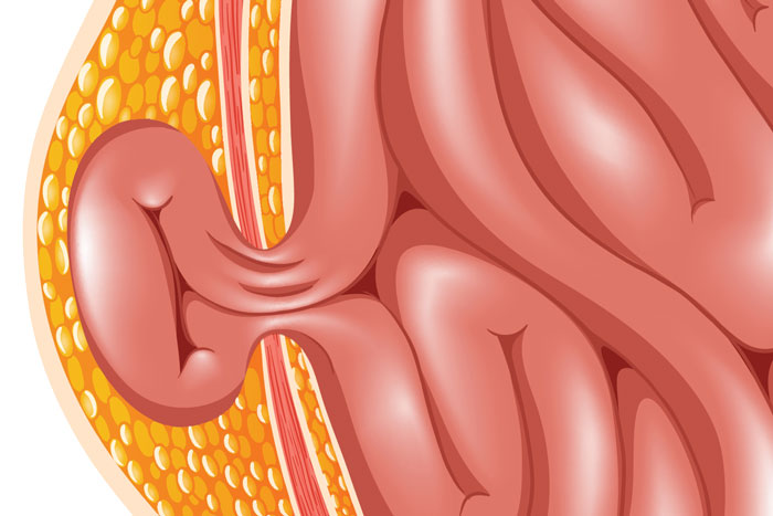 hernia cross section illustration