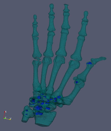 Hand CT to evaluate RA erosions
