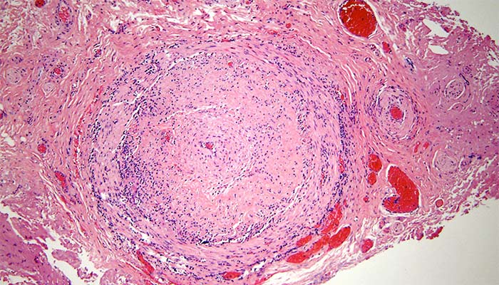 Temporal Artery Biopsy