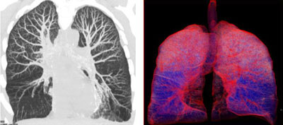 Maximum Intensity Projection