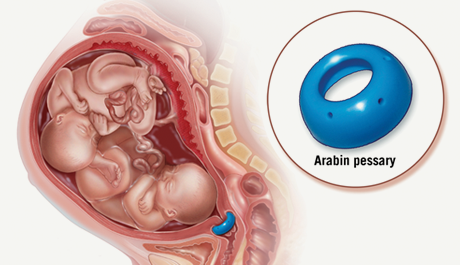 Arabin Pessary Diagram